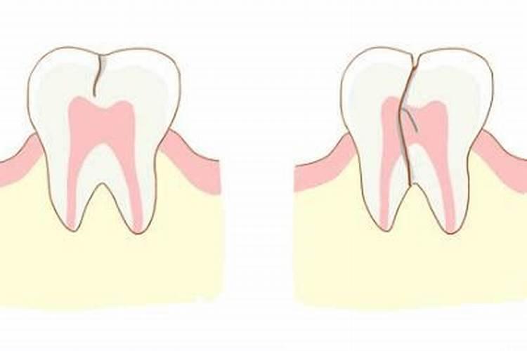 梦到牙齿碎裂掉是什么原因